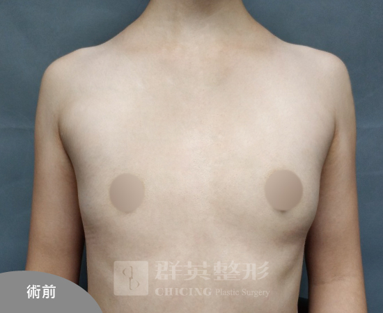 台北群英_黃馨慧醫師_魔滴隆乳70