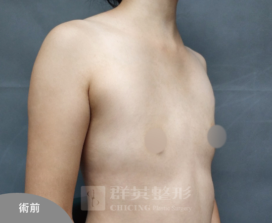 台北群英_黃馨慧醫師_魔滴隆乳69