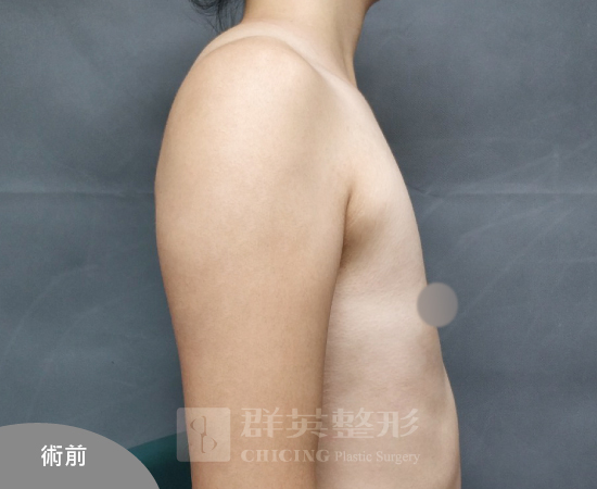台北群英_黃馨慧醫師_魔滴隆乳68