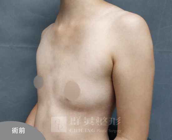 台北群英_黃馨慧醫師_魔滴隆乳67