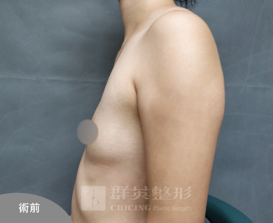 台北群英_黃馨慧醫師_魔滴隆乳66