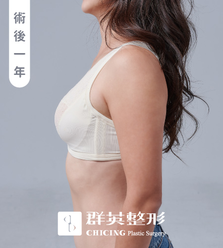 群英黃馨慧醫師_魔滴隆乳術後內衣照093014
