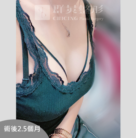 台中群英_王冠穎醫師_魔滴隆乳48
