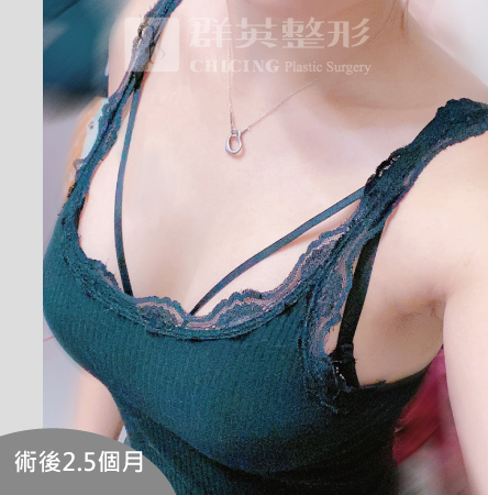 台中群英_王冠穎醫師_魔滴隆乳47