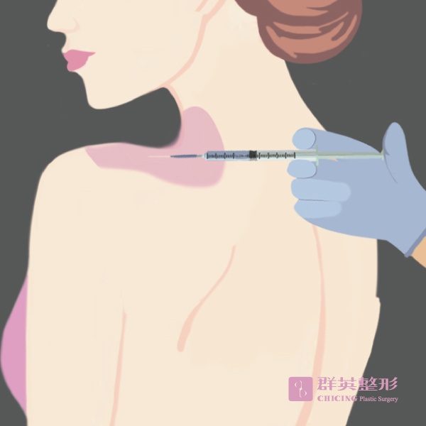 侯憲棋醫師 水牛肩 天使肩 美人肩 肉毒桿菌素注射