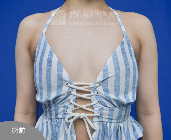 台北群英_黃志宏醫師_魔滴隆乳39