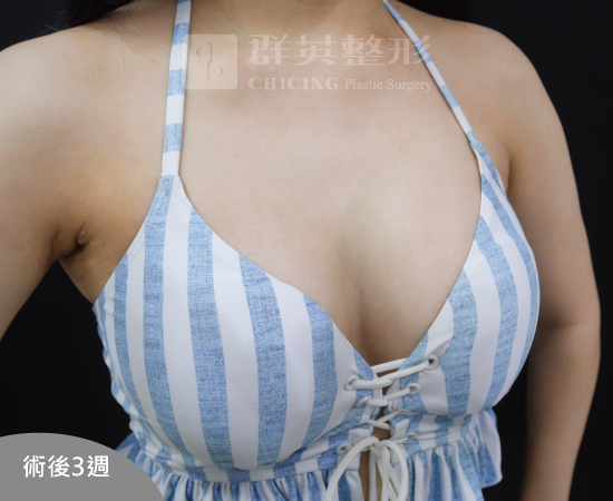 台北群英_黃志宏醫師_魔滴隆乳33