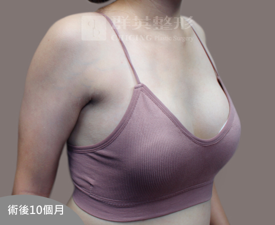 台中群英_林雍球醫師_魔滴隆乳12