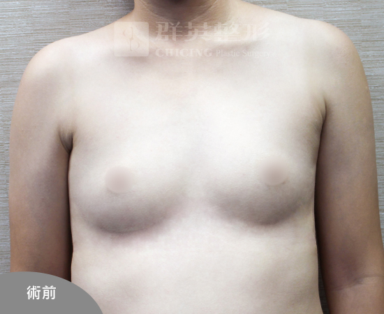台中群英_林雍球醫師_魔滴隆乳23