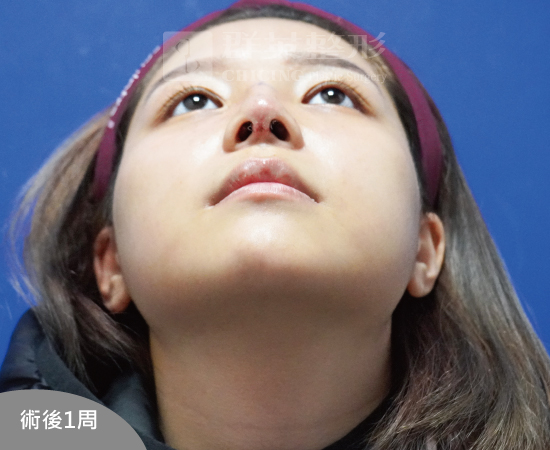 高雄群英_蘇毓彬醫師_Goretex隆鼻32
