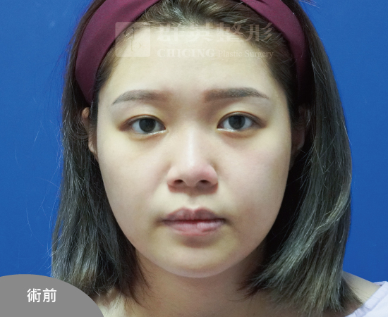 高雄群英_蘇毓彬醫師_Goretex隆鼻45