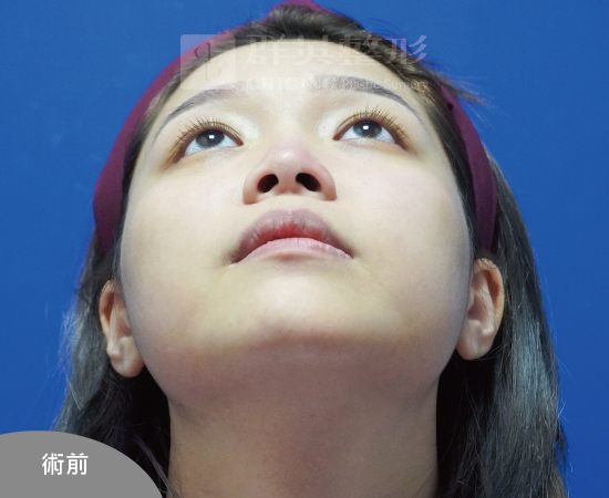 高雄群英_蘇毓彬醫師_Goretex隆鼻44