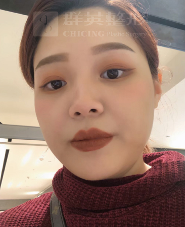高雄群英_蘇毓彬醫師_Goretex隆鼻39