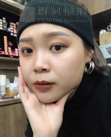 高雄群英_蘇毓彬醫師_Goretex隆鼻37