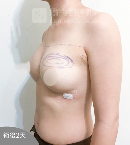高雄抽脂豐胸_高雄群英_王冠穎醫師_27