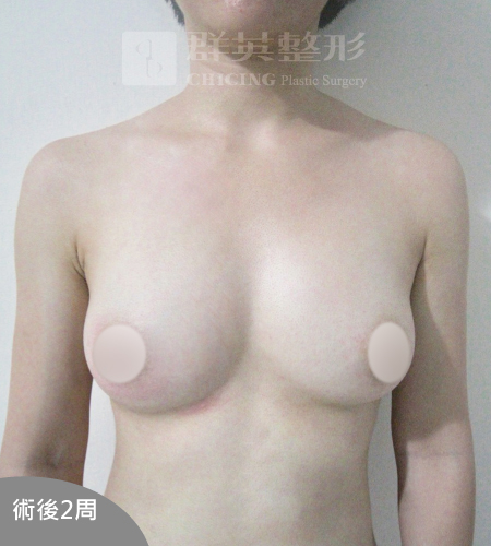 高雄抽脂豐胸_高雄群英_王冠穎醫師_20