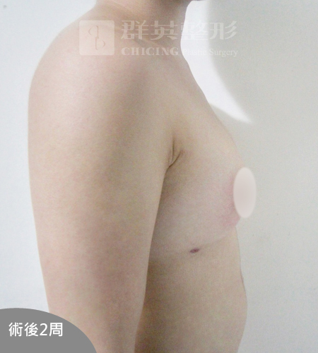 高雄抽脂豐胸_高雄群英_王冠穎醫師_18