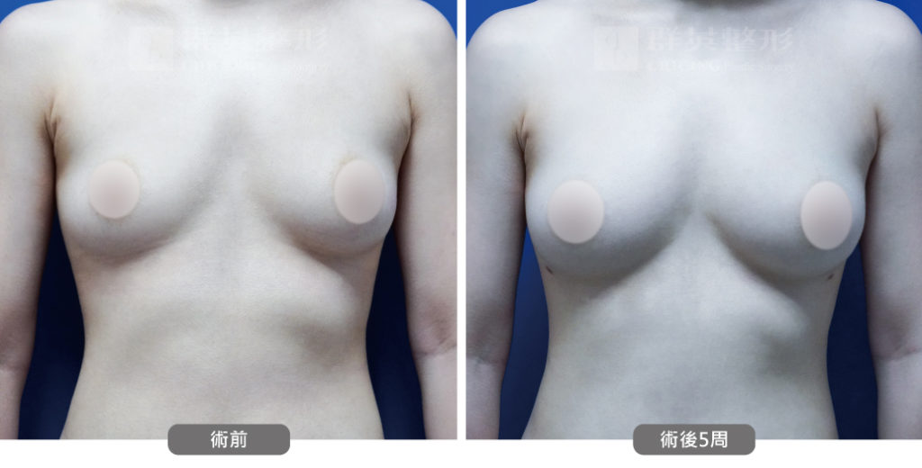 高雄抽脂豐胸_高雄群英_王冠穎醫師_10