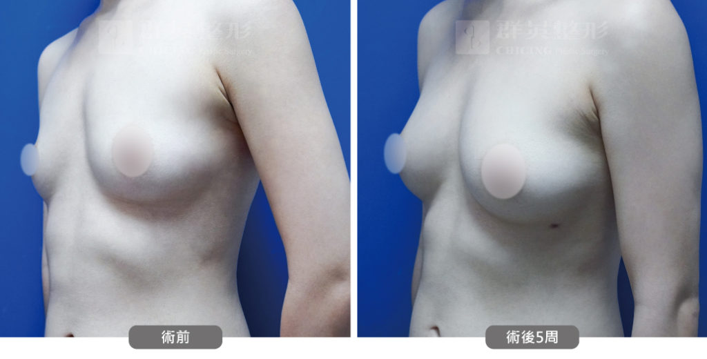 高雄抽脂豐胸_高雄群英_王冠穎醫師_09