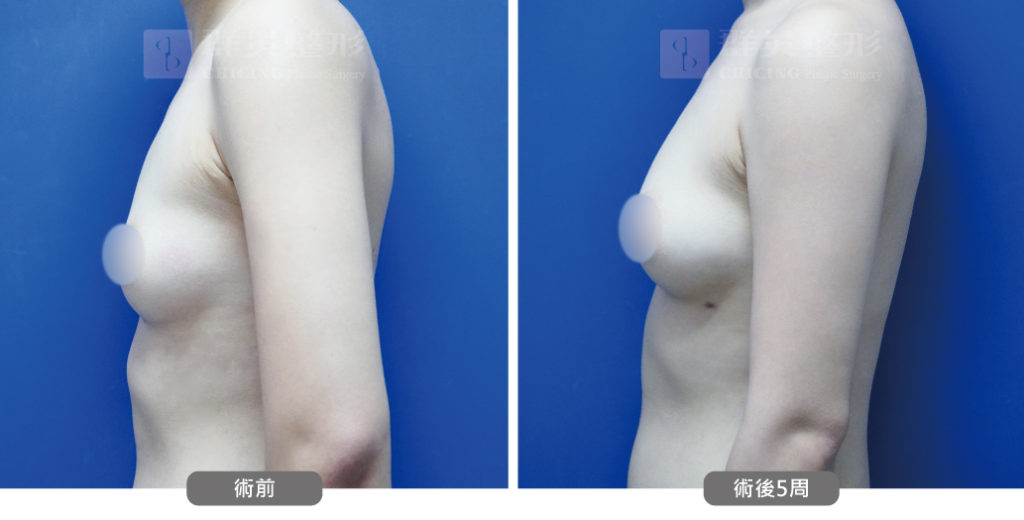 高雄抽脂豐胸_高雄群英_王冠穎醫師_08