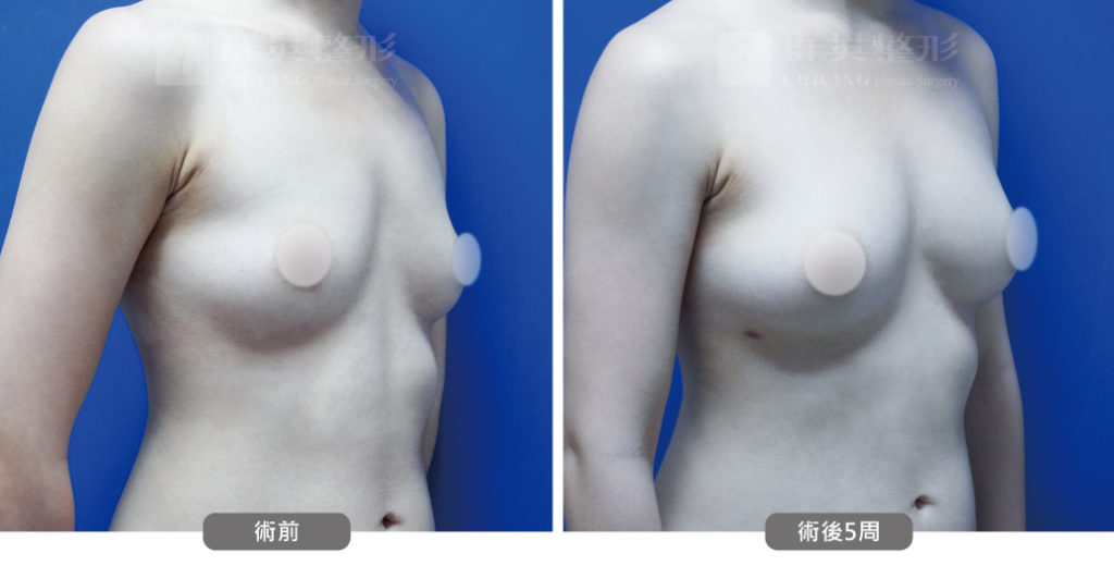 高雄抽脂豐胸_高雄群英_王冠穎醫師_07