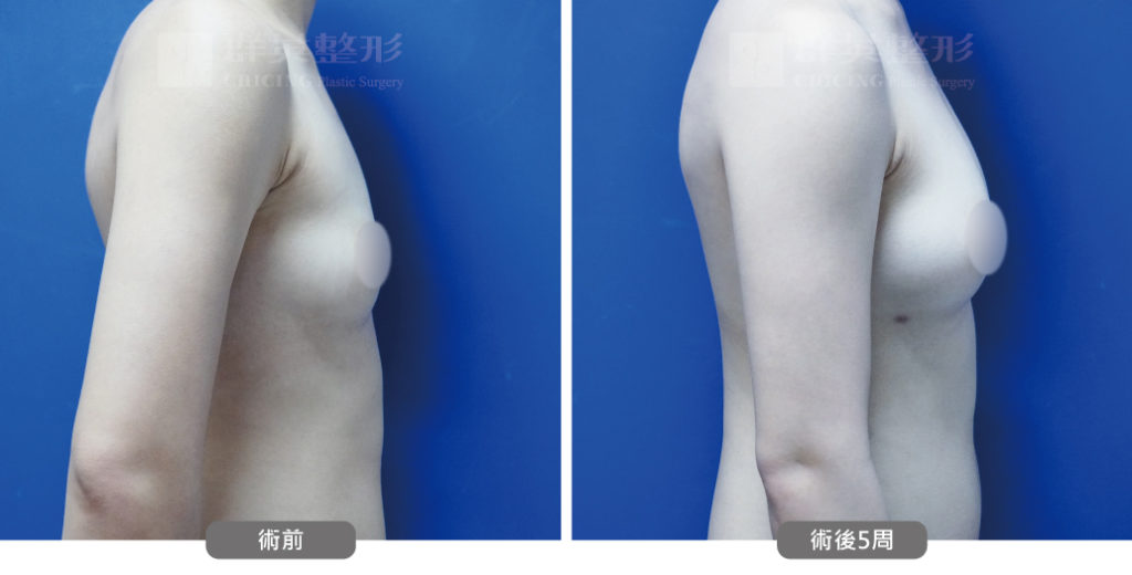 高雄抽脂豐胸_高雄群英_王冠穎醫師_06