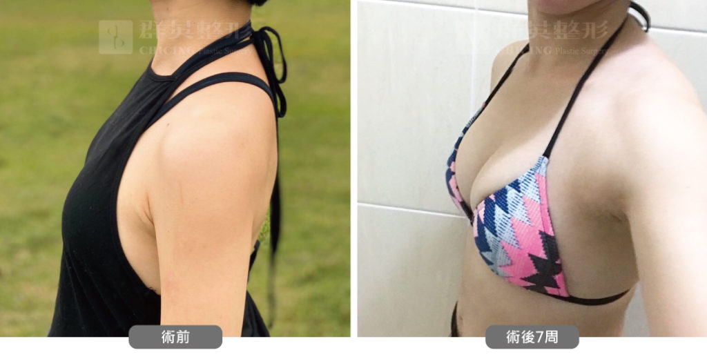 高雄抽脂豐胸_高雄群英_王冠穎醫師_05