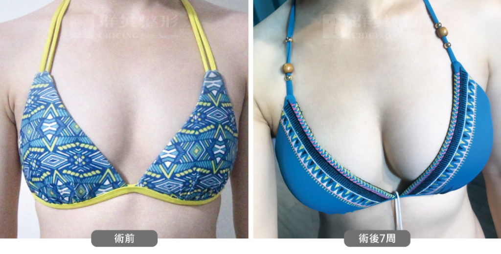 高雄抽脂豐胸_高雄群英_王冠穎醫師_04