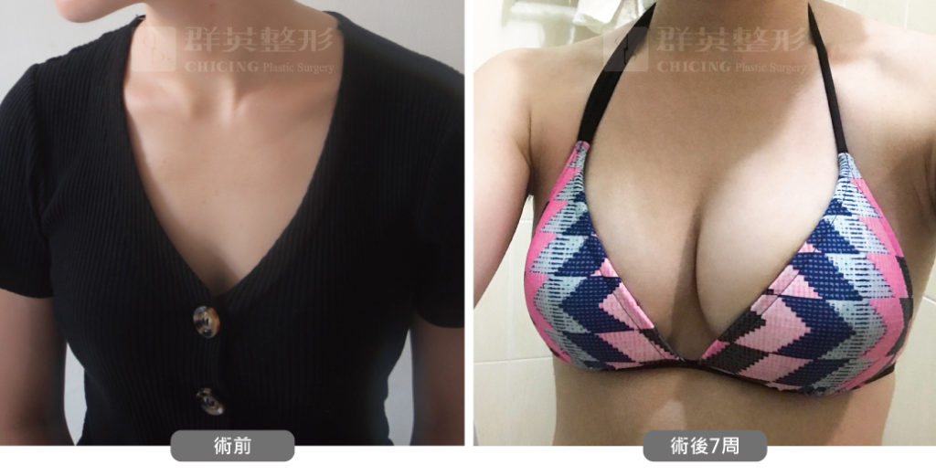高雄抽脂豐胸_高雄群英_王冠穎醫師_03