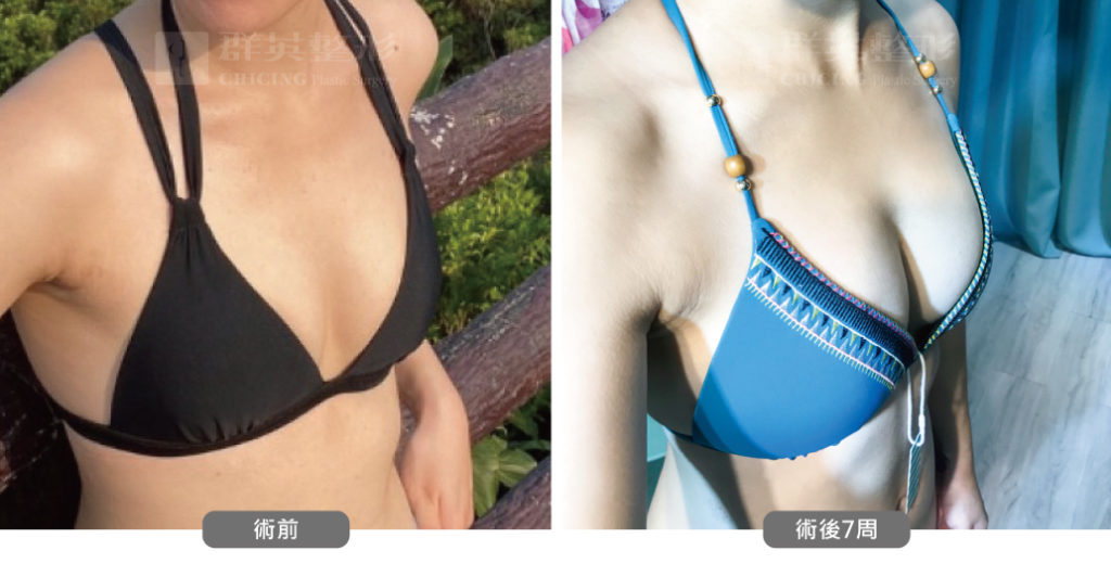高雄抽脂豐胸_高雄群英_王冠穎醫師_02