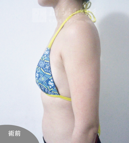 高雄抽脂豐胸_高雄群英_王冠穎醫師_37