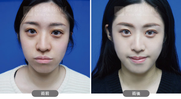 陳廣得醫師_複合式眼周治療