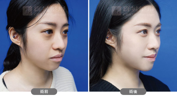 陳廣得醫師_複合式眼周治療