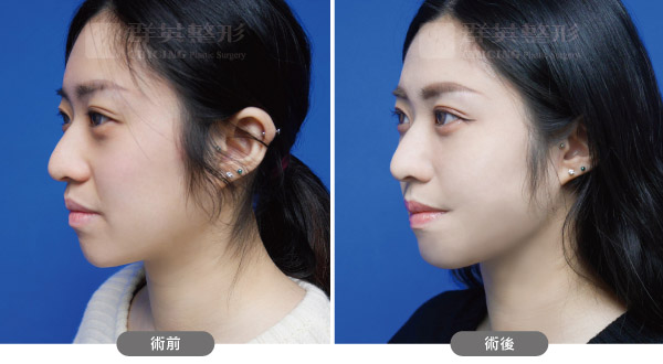 陳廣得醫師_複合式眼周治療