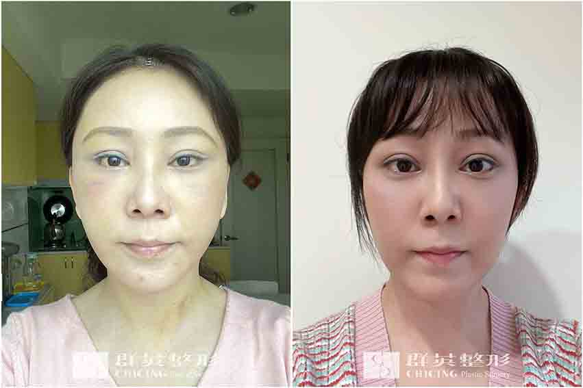 張世幸醫師_複合式拉皮案例