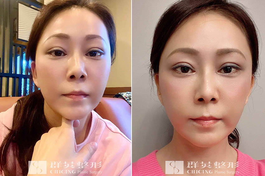 張世幸醫師_複合式拉皮案例