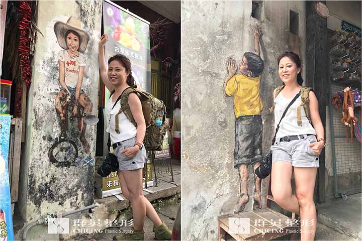 蘇瑋智醫師_體雕、抽脂、腿部環抽案例
