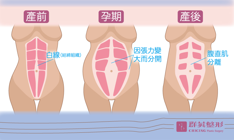群英陳彥州醫師_腹部拉皮產前產後變化