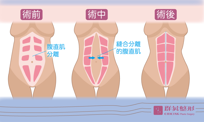 群英陳彥州醫師_腹部拉皮術前術後示意圖