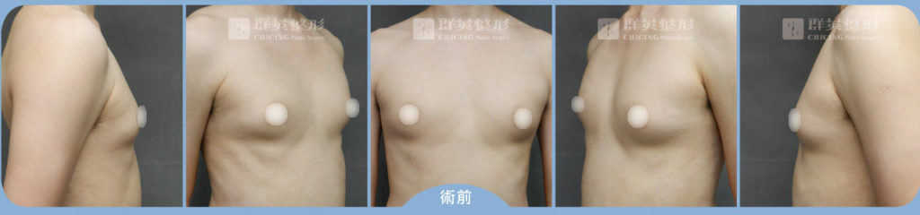 張世幸醫師_男性女乳症案例