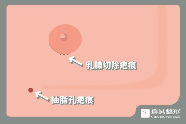 張世幸醫師_男性女乳症案例