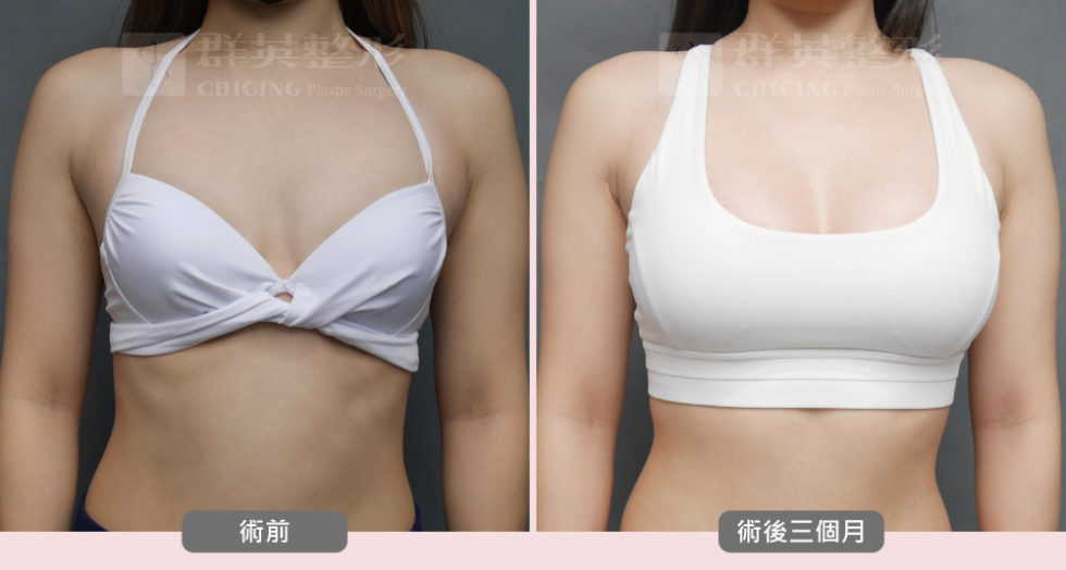 陳大正醫師_魔滴隆乳_真實案例_群英整形外科