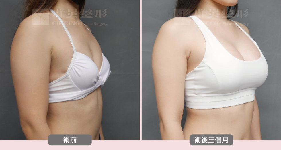 陳大正醫師_魔滴隆乳_真實案例_群英整形外科