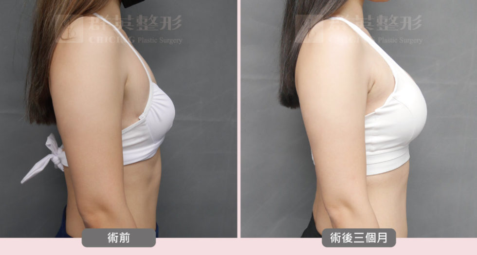 陳大正醫師_魔滴隆乳_真實案例_群英整形外科