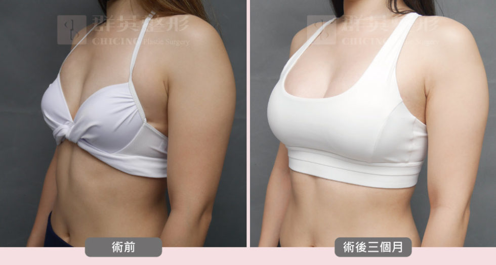 陳大正醫師_魔滴隆乳_真實案例_群英整形外科