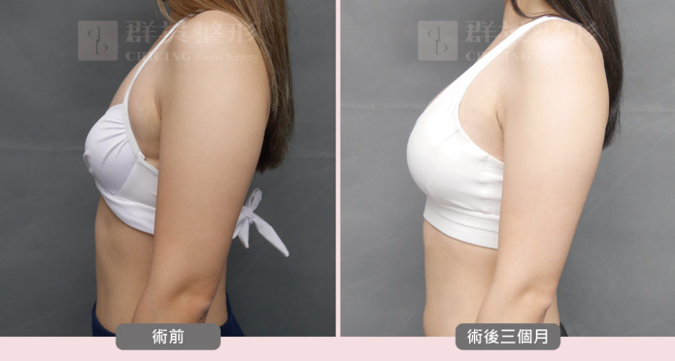 陳大正醫師_魔滴隆乳_真實案例_群英整形外科