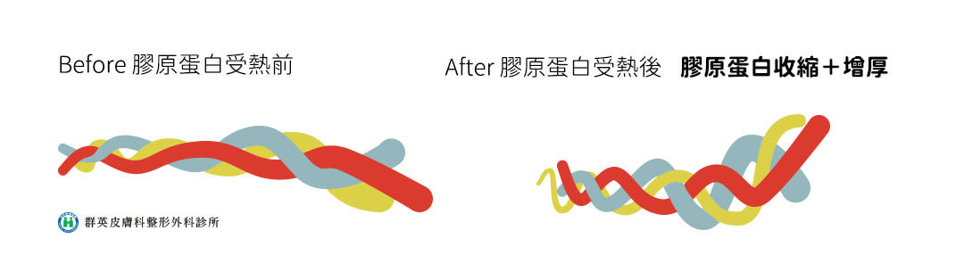 麗芙音波_音波電波比較_音波拉提價格