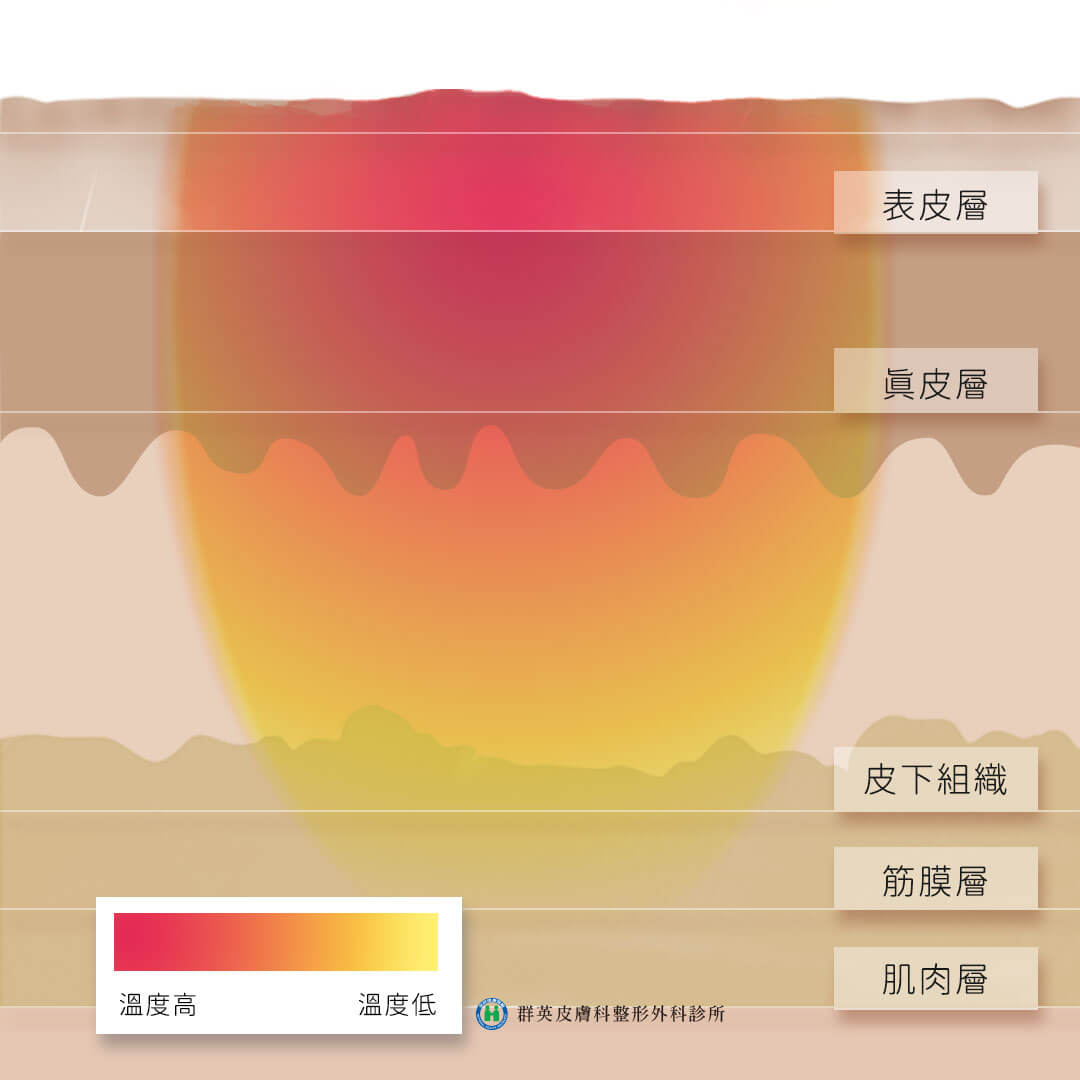 電波音波比較_電波治療皺紋