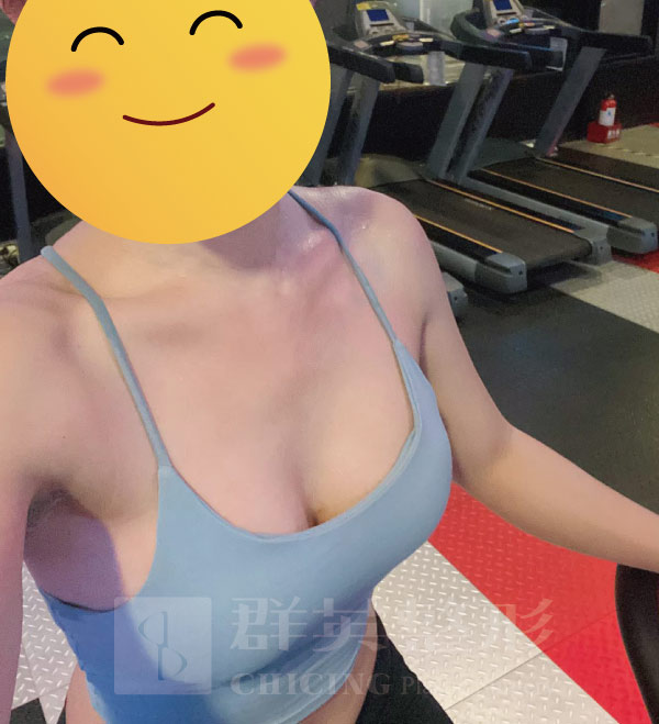 陳大正醫師_魔滴隆乳_真實案例_群英整形外科