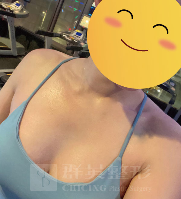 陳大正醫師_魔滴隆乳_真實案例_群英整形外科